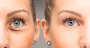 Eyelid Surgery