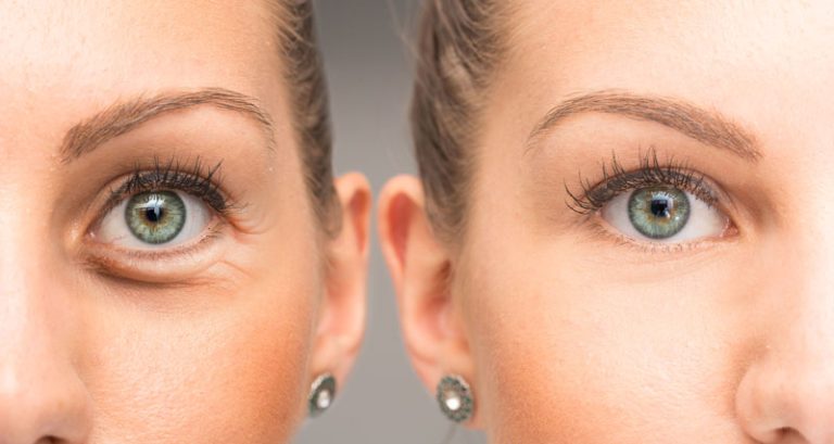 Read more about the article Eyelid Surgery